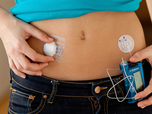 Wellness Diabetes: Insulin Pump For Uncontrolled Diabetes
